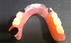 義歯：ノンクラスプデンチャー 両側(部分入れ歯)