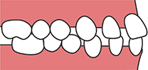 空隙歯列（すきっ歯）
