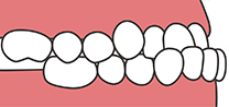 下顎前突（受け口）