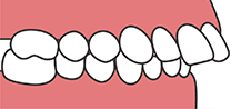 上顎前突（出っ歯）