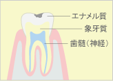 軽度の虫歯