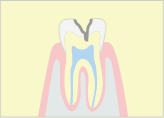 中度の虫歯
