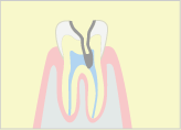 重度の虫歯