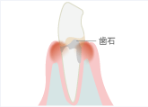 軽度歯周炎