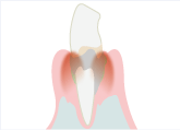中度歯周炎