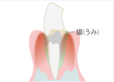 重度歯周炎