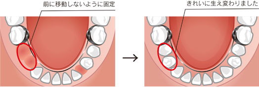 リンガルアーチのイラスト