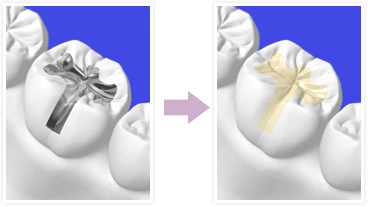 詰め物や被せもの